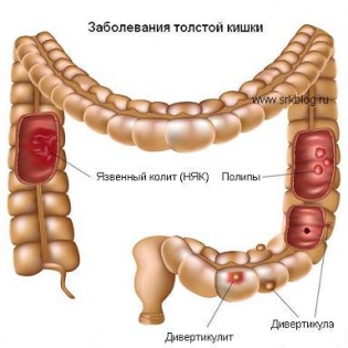 Слизь с кровью в стуле